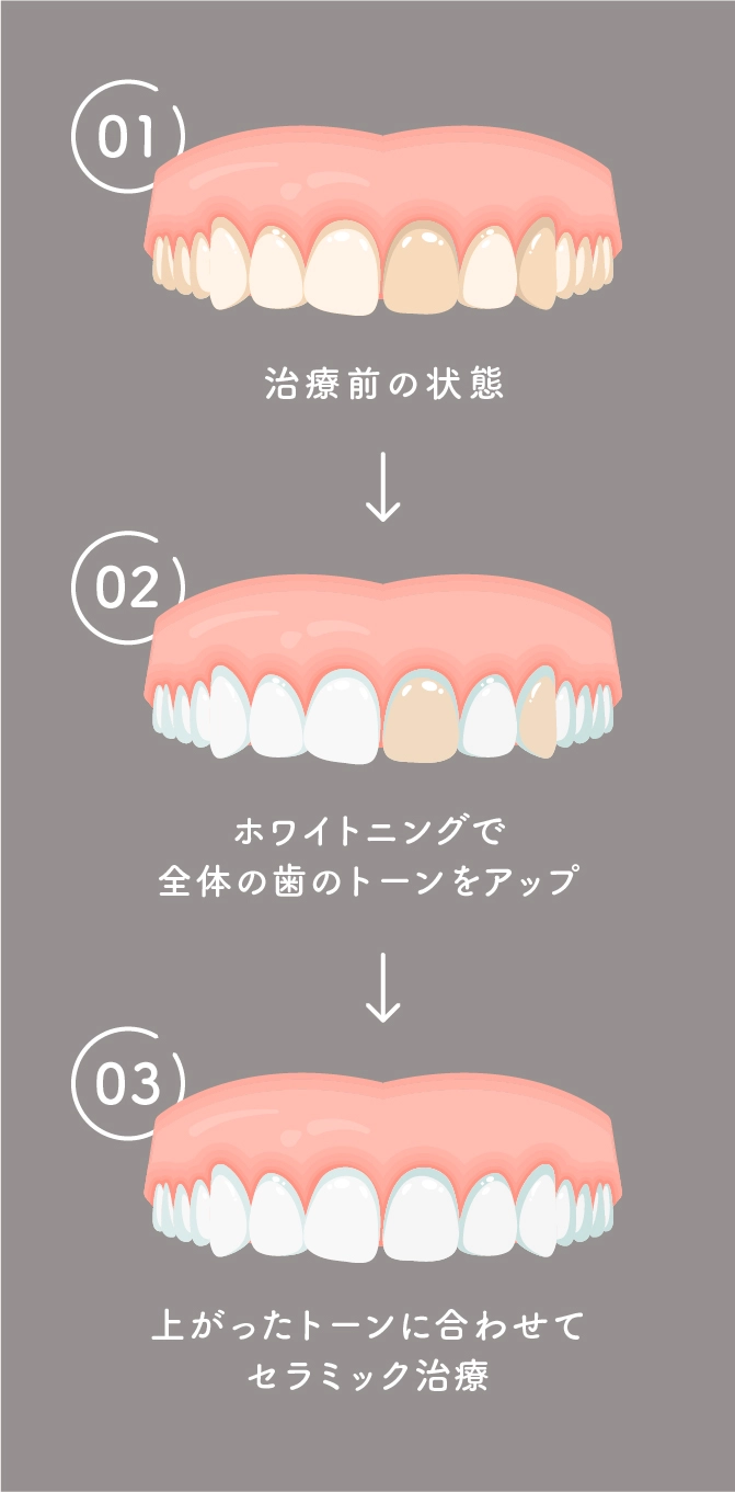 ホワイトニングと並行して治療する場合の流れ