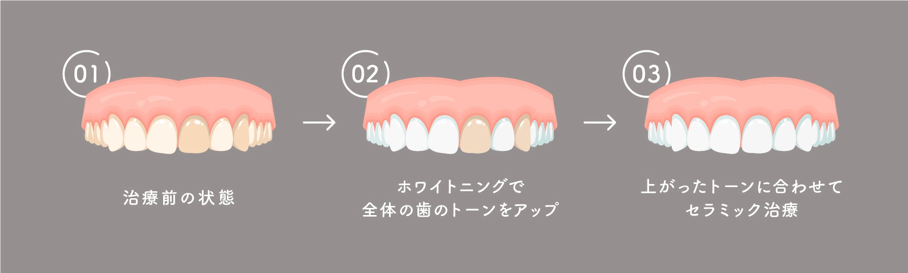 ホワイトニングと並行して治療する場合の流れ